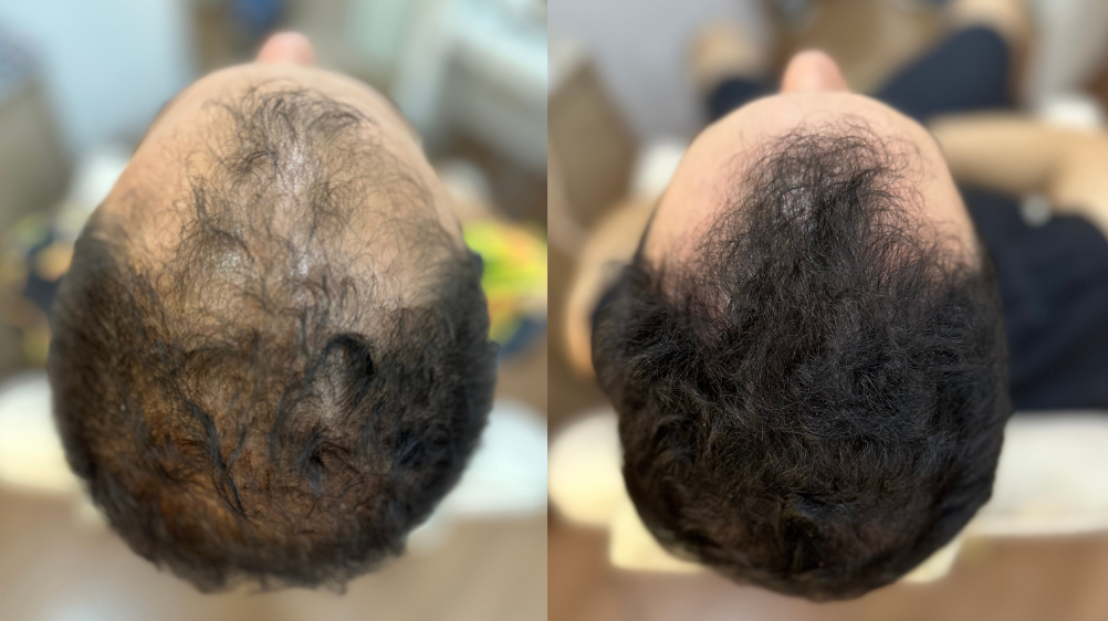 tratamento capilar, alopecia e queda de cabelo